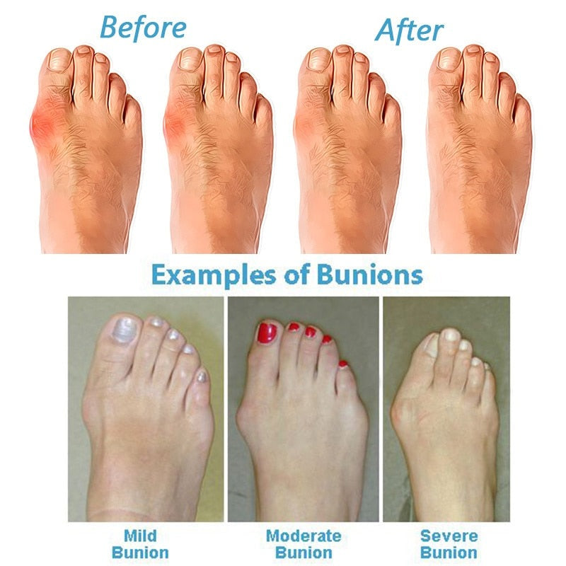 OrthoSandels - Orthopedische & Corrigerende Sandalen voor Bunions